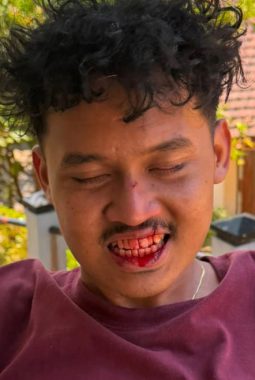 Konferda GMNI Jatim Ricuh, Ketua DPC GMNI Jember Mengaku Dihantam Batu hingga Bibir Robek
